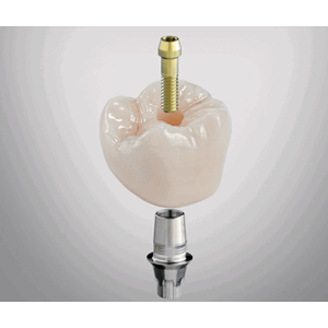 CEREC Tessera Abutment LT A1 A16 S 3 stk